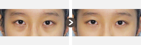 目の下の脂肪再配置(結膜)