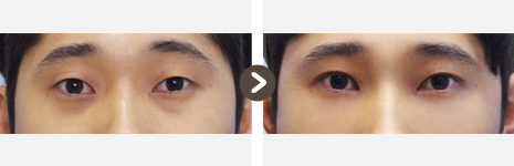 目の下の脂肪再配置(結膜) + 非切開目つき矯正